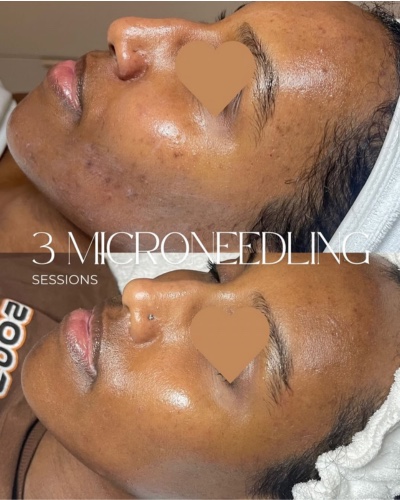 Cheek and jawline before and after a course of three microneedling sessions.